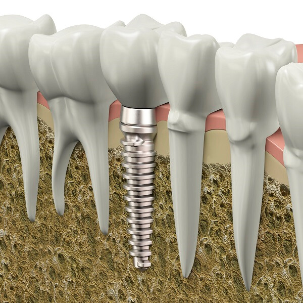 Dental Implant in bone graphic