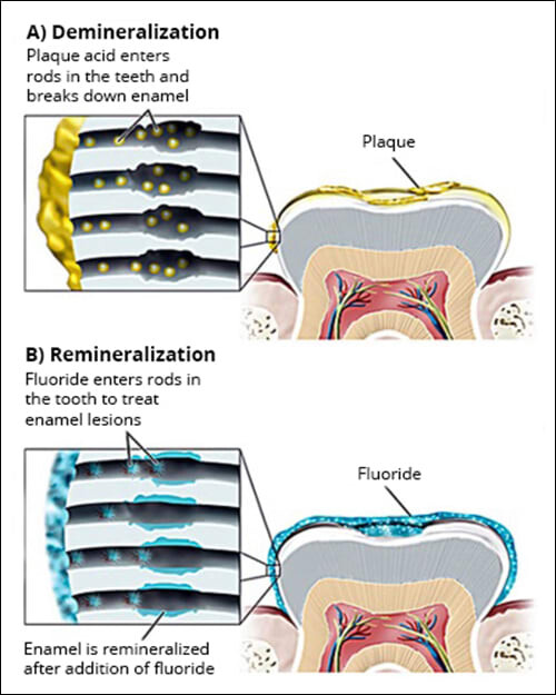 Diagram showing the beneficial action of fluoride on teeth!